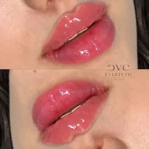 MODELOWANIE UST - Modelowanie ust 1ml - zdjęcie 8