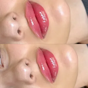 MODELOWANIE UST - Modelowanie ust 0,5 ml - zdjęcie 6