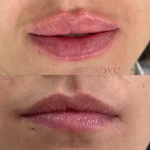 MODELOWANIE UST - Modelowanie ust 0,5 ml - zdjęcie 2